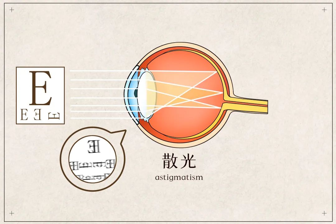 同时有散光和近视怎么办？