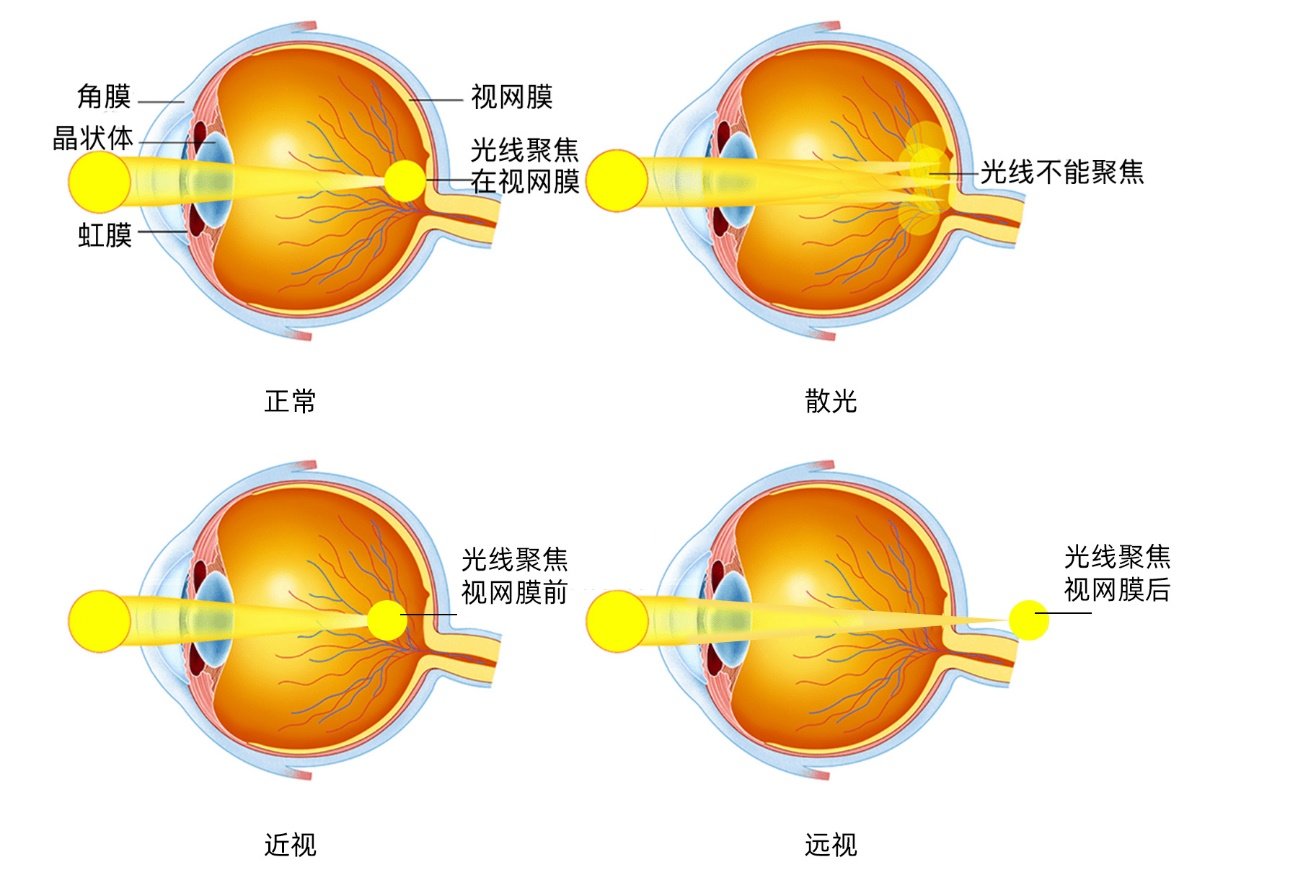 近视、老花和散光一样吗？该如何科学预防？