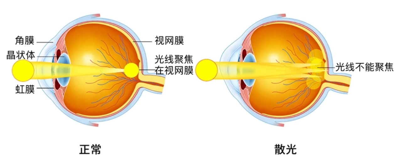 散光是怎么回事？眼睛有散光该怎么办